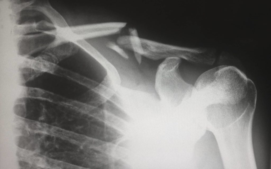 photo of broken shoulder of a xray following a car accident